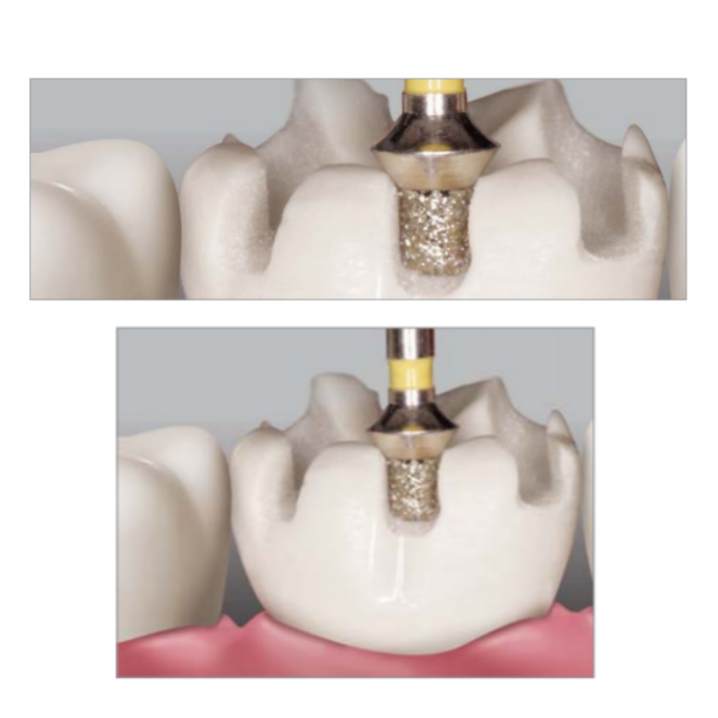 Diamond Bur Occlusal Reduction J&S Davis